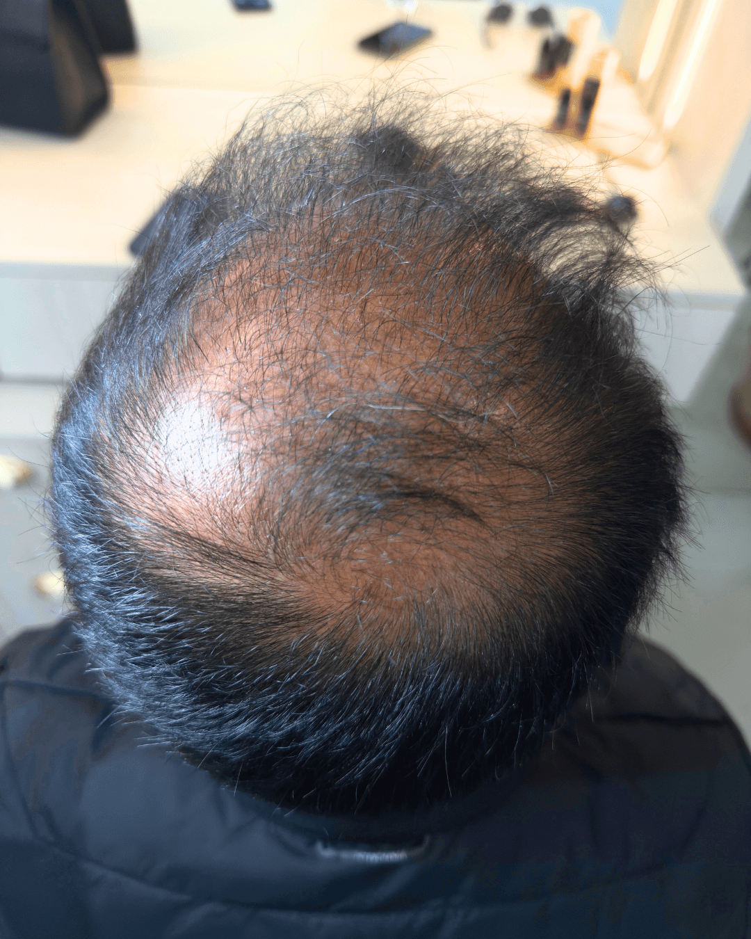 The same crown with denser coverage after the Hair Therapy Protocol