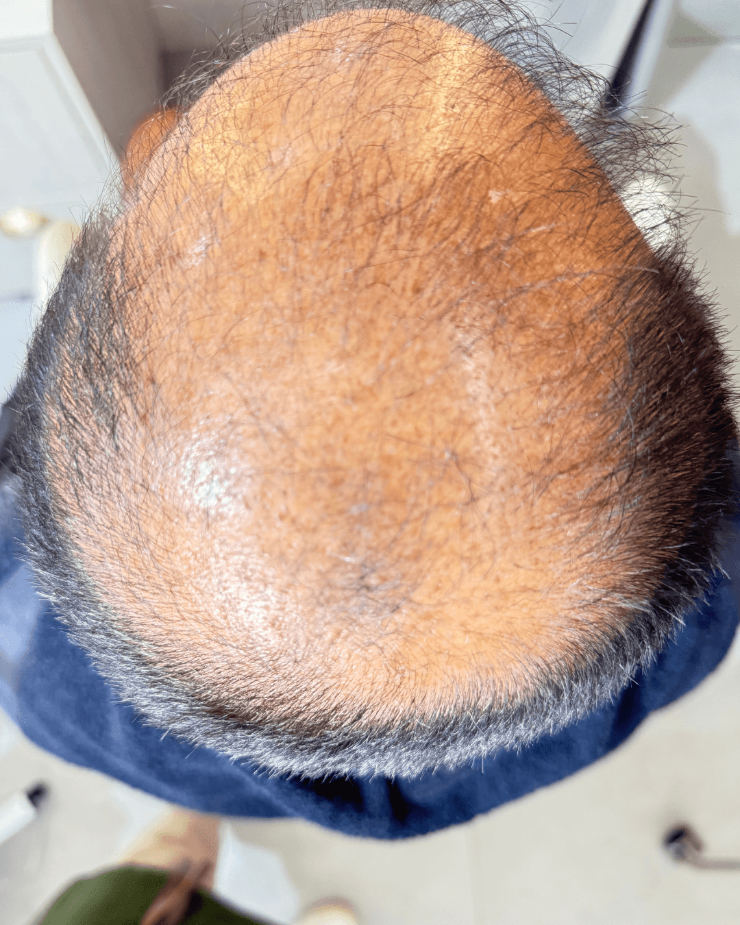 Client's crown with visible thinning before the Hair Therapy Protocol